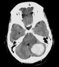 Cerebellum Penetrating branches of the PICA, AICA, SCA Abrupt onset vertigo, inability to walk in absence of weakness Ipsilateral ataxia, horizontal gaze palsy,