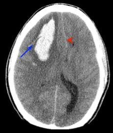 Lobar hemorrhage Penetrating cortical branches of ACA, MCA, & PCA Major neurologic deficit Occipital hemorrhage - hemianopia Left temporal