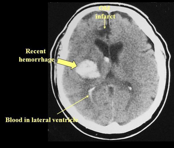 Basal ganglia Ascending lenticulostriate branches of MCA Wide spectrum of severity extending to coma and decerebrate rigidity Contralateral hemiplegia, hemianesthesia, and