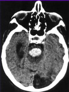 Pons Paramedian branches of the basilar artery Bilateral carries very poor prognosis (coma, quadriplegia, decerebrate posturing,