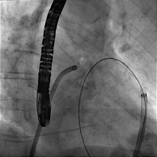 Transeptal catheter in place Lariet delivery