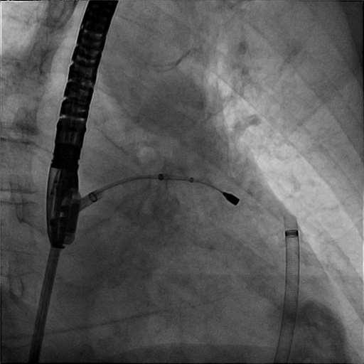 Magnet wire is advanced to the tip of the left atrial appendage and