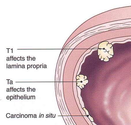 TNM Staging of TCC bladder Superficial T1 invades lamina