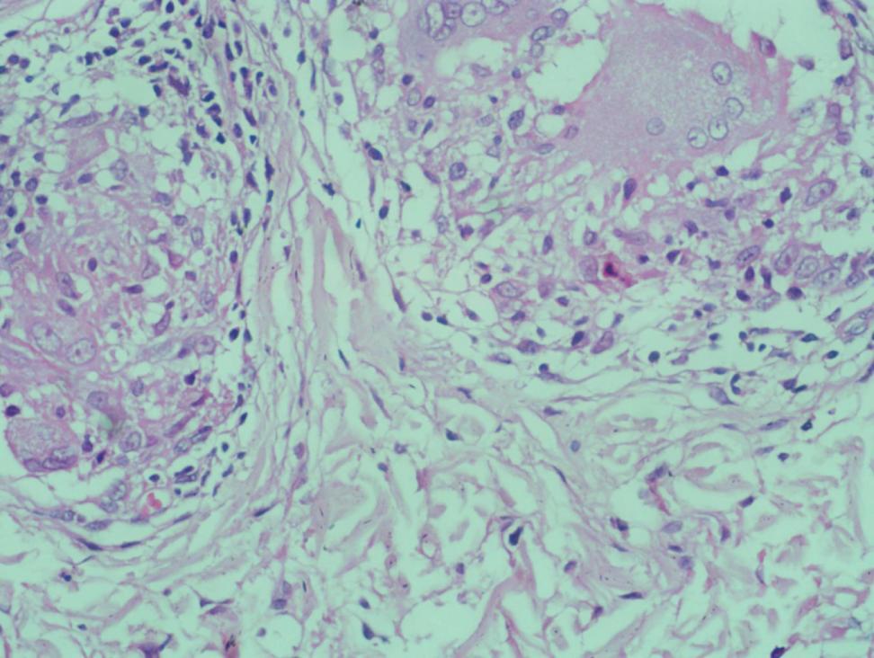 Pathology In some patients the lesions consist mainly of epithelioid granulomas.