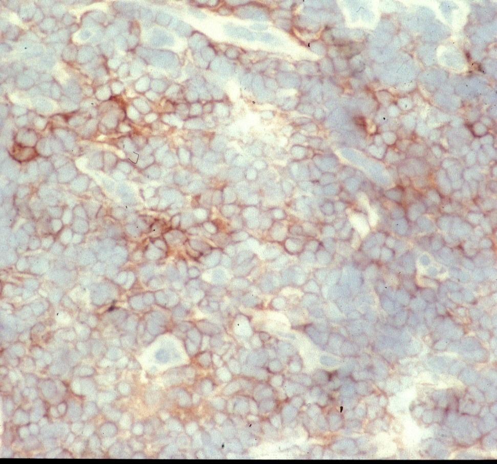 Langerhans cells in PKDL Dermal infiltrate of PKDL lesion