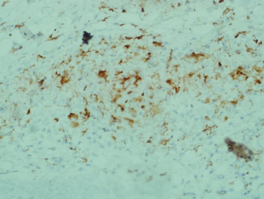 Other cells in the PKDL lesion CD 68