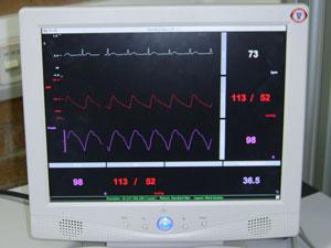 patients ECG can be displayed on the monitor when the leads are applied The monitor can also display the following; central venous pressure, temperature,