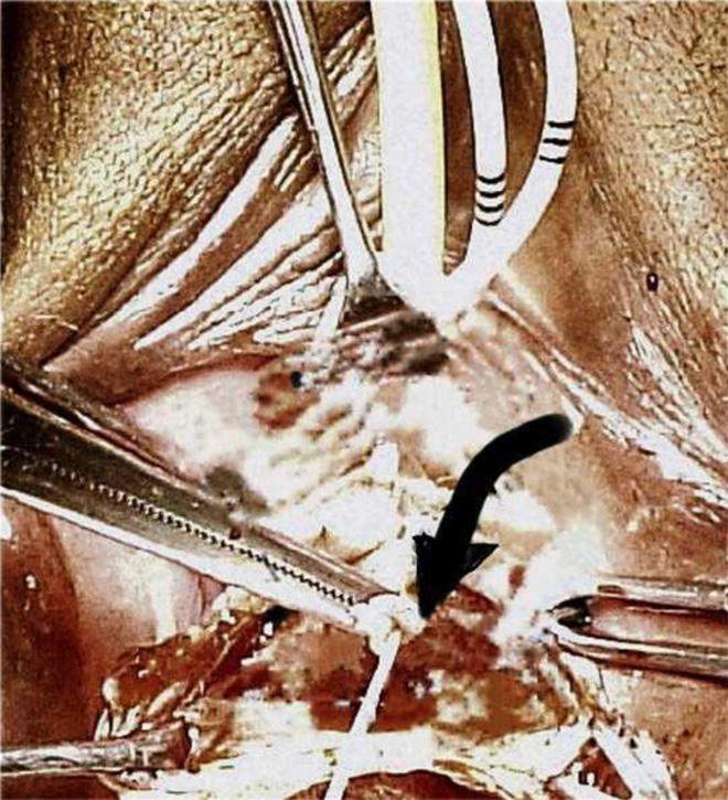Martius flap and anterior vaginal wall sling 177 Figure 1 Dissection of the fistulous tract around the ureteric catheter. Figure 3 Creation of a Martius flap to cover the urethral suture line.