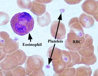 Eosinophils Low no real cause for concern Eosinophils High Most common causes: allergy/atopy: asthma/hayfever