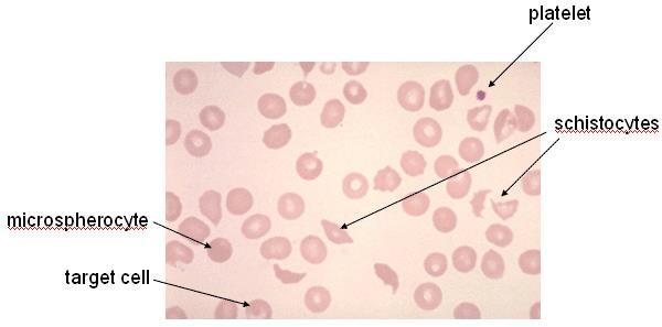Microcytic Anemia The three most common causes for microcytic