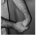 Forearm brace reduces pull on tendon origin Variable