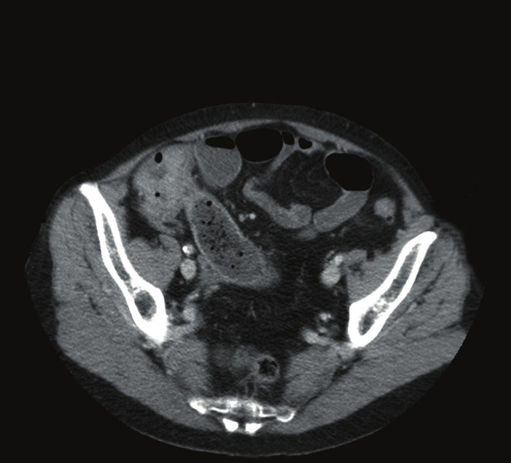 Port placement for the radical nephrectomy was not in an altered configuration. The colon was reflected medially by dissecting the Toldt fascia, exposing the anterior aspect of the left kidney.