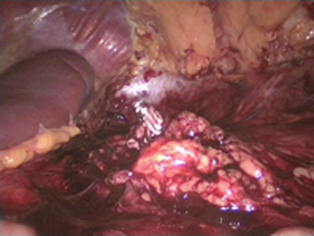 This case report confirms that left radical nephrectomy and right hemicolectomy can be combined in one laparoscopic procedure.