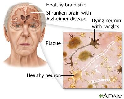 Alzheimer s: a disease