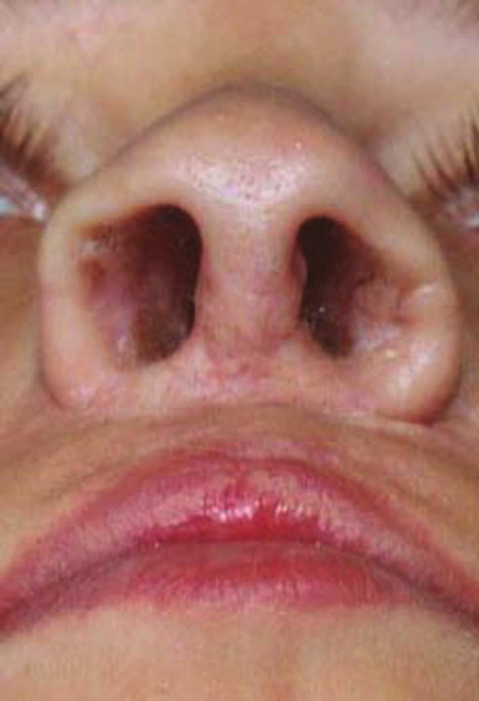 1390 PLASTIC AND RECONSTRUCTIVE SURGERY, April 1, 2002 FIG. 4. An overly long columella, resulting in flip nasal deformity.