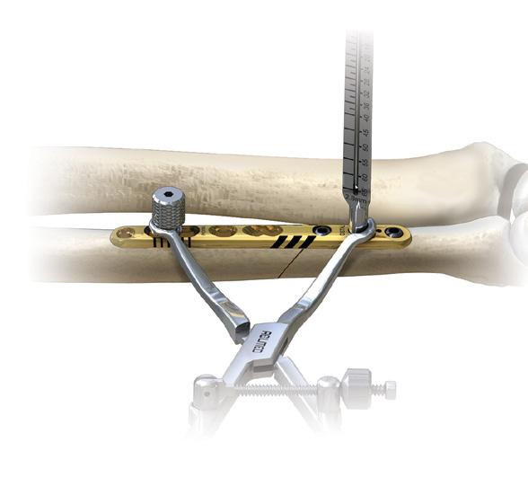 Osteotomy With Guide Technique [continued] 9 Secondary Locking Drill Guide Placement Place a bone clamp over the distal portion of the ulna and plate to reduce the gap in between them.