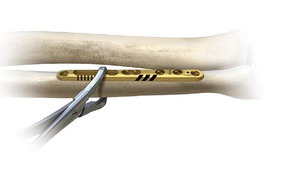 Secure the 6-Hole Ulna Shortening Plate (PL-UL06) to the volar surface with one or more clamps, such as the Reduction Forceps with Serrated Jaw (PL-CL04).