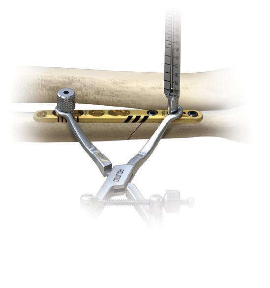 Reduce the osteotomy gap with the reduction clamp and tighten the speed-lock wheel on the clamp to maintain reduction hands-free.