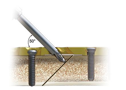 5 mm glide hole and use a Quick Release Drill (80-0387) to drill the far cortex (Figure 30). Measure and insert a 3.5 mm Cortical or Nonlocking (CO-3XXX or 30-XXXX).