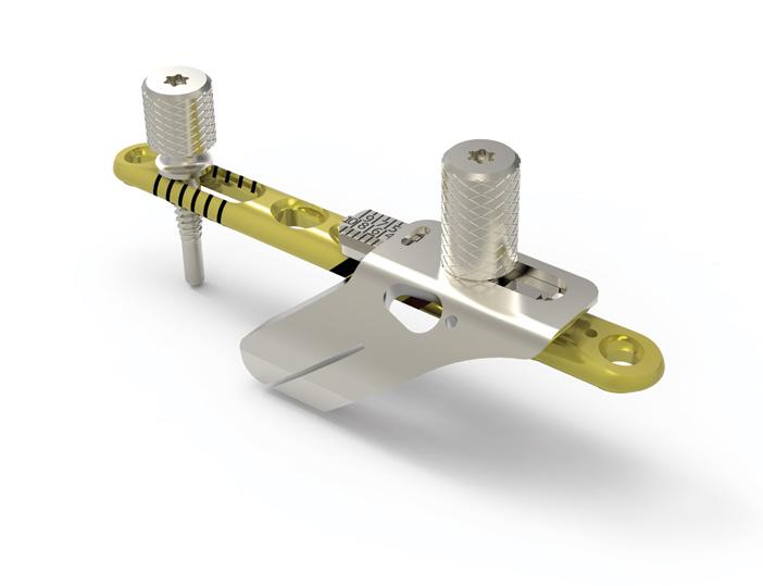 The interfragmentary screw may be placed in one of two locations through the scalloped slot and is intended to compress the osteotomy securely when used as a lag screw.