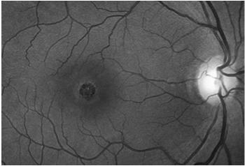 Full Thickness Macular Hole