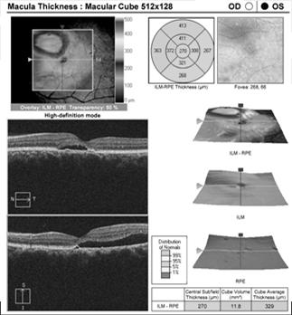 3Types of OCT Scans Retina scan Glaucoma scan Anterior Segment scan The