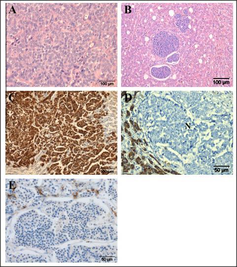 Canine HCC with high potential for metastasis H&E H&E