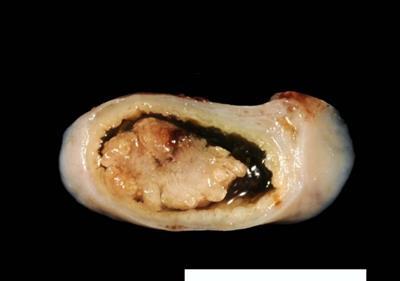 Gall bladder Neoplasia Epithelial Gall bladder adenoma