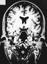 MRI scan of patient with incipient Alzheime s