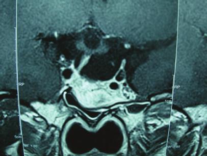 (b) Coronal T2-weighted MRI showing a hyperintense lesion within the pituitary floor and deviation of the pituitary stalk to the right side.