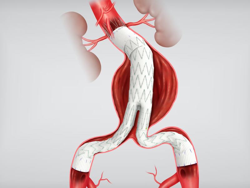 Background Endovascular aneurysm repair (EVAR) Over last 25 years, EVAR has become the most common repair strategy for treatment of infrarenal aortic