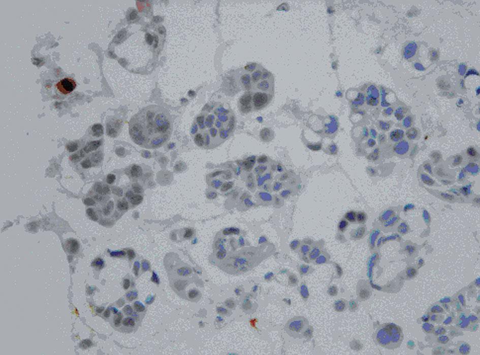 CARCINOMA CARCINOMA CARCINOMA TUMOUR TUMOUR TUMOUR Male 8 2 0 0 2 0 0 0 12 Female 11 0 2 2 0 34 1 1 51 Total 19 2 2 2 2 34 1 1 63 NOS not otherwise specified Immunohistochemical analysis D2-40 In