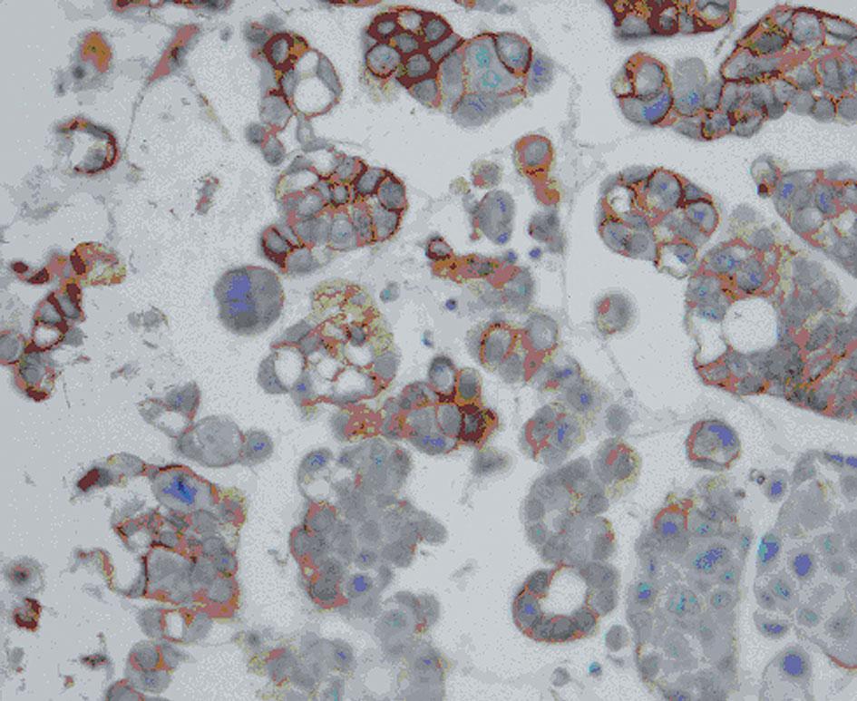 FERESHTEH ENSANI, FARNAZ NEMATIZADEH, GITI IRVANLOU reactive mesothelial cells of which only 2 (3.7%) cases demonstrated positive membranous staining.