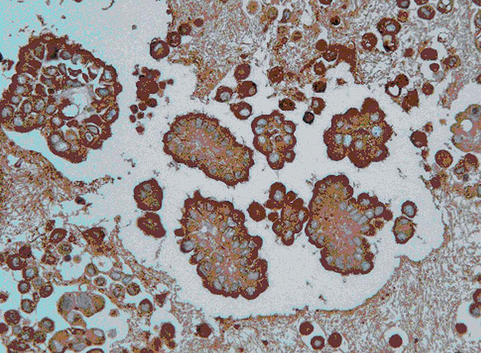 Original magnification 400 Both membranous and cytoplasmic positive staining were noted in both (100%) malignant mesothelioma cases regarding both malignant and background reactive mesothelial cells