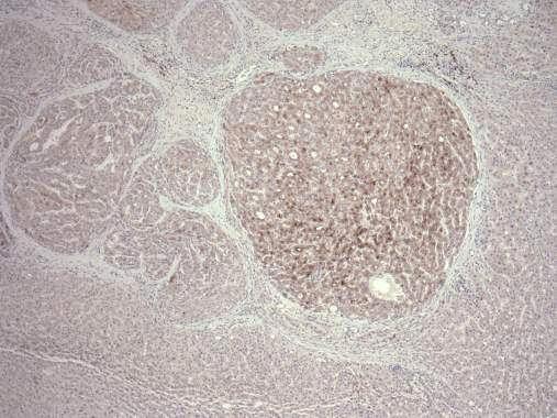 dysplasia membranous, canalicular, cytoplasmic