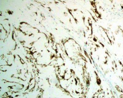 Figure 6 Figure 8 Figure 6: The spindle and stellate cells are positive for glial fibrillary acidic protein (GFAP) Figure 8: Vimentin shows diffuse and strong staining.