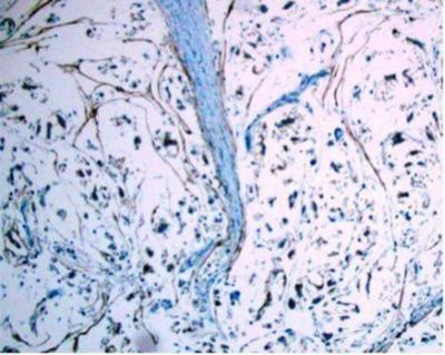 X20 Nerve sheath myxoma (NSM) is a rare benign lesion that was originally defined by Harkin and Reed (1).