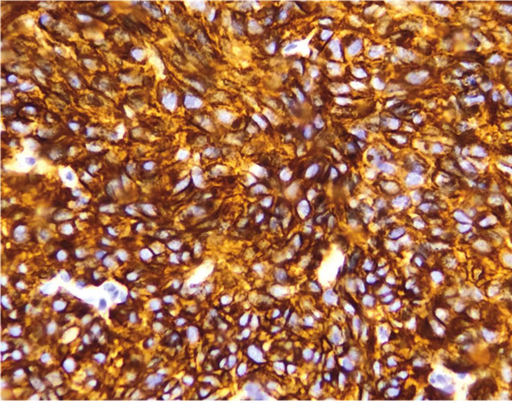 Figure 6: KIT IHC - diffuse, strong cytoplasmic, and membranous