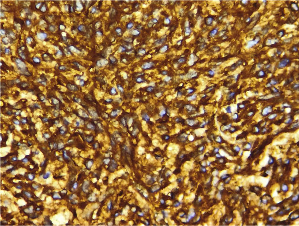 stromal tumors showing vacuolated cytoplasm, H and E ( 40) IHC for SMA