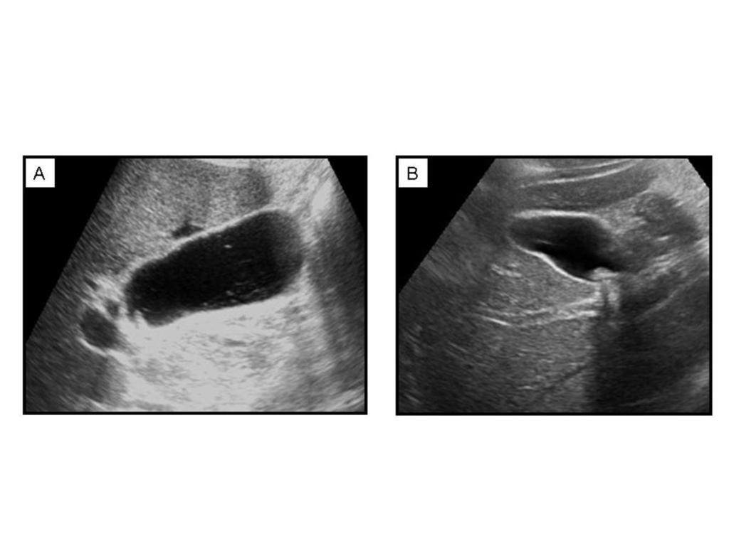 Fig. 15: Figure A. Longitudinal US image shows biliary sludge in a 11-year-old children with CF. Figure B.