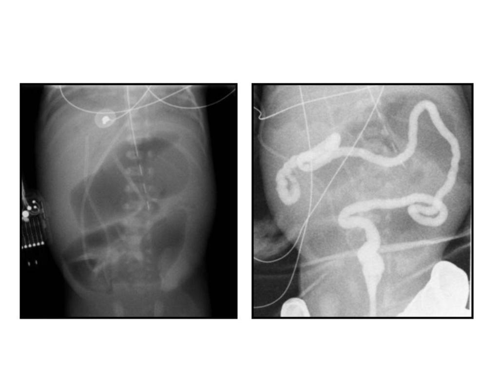 Fig. 18: Newborn presents with abdominal distention, bilious emesis, and failure to pass meconium within 48 hours.
