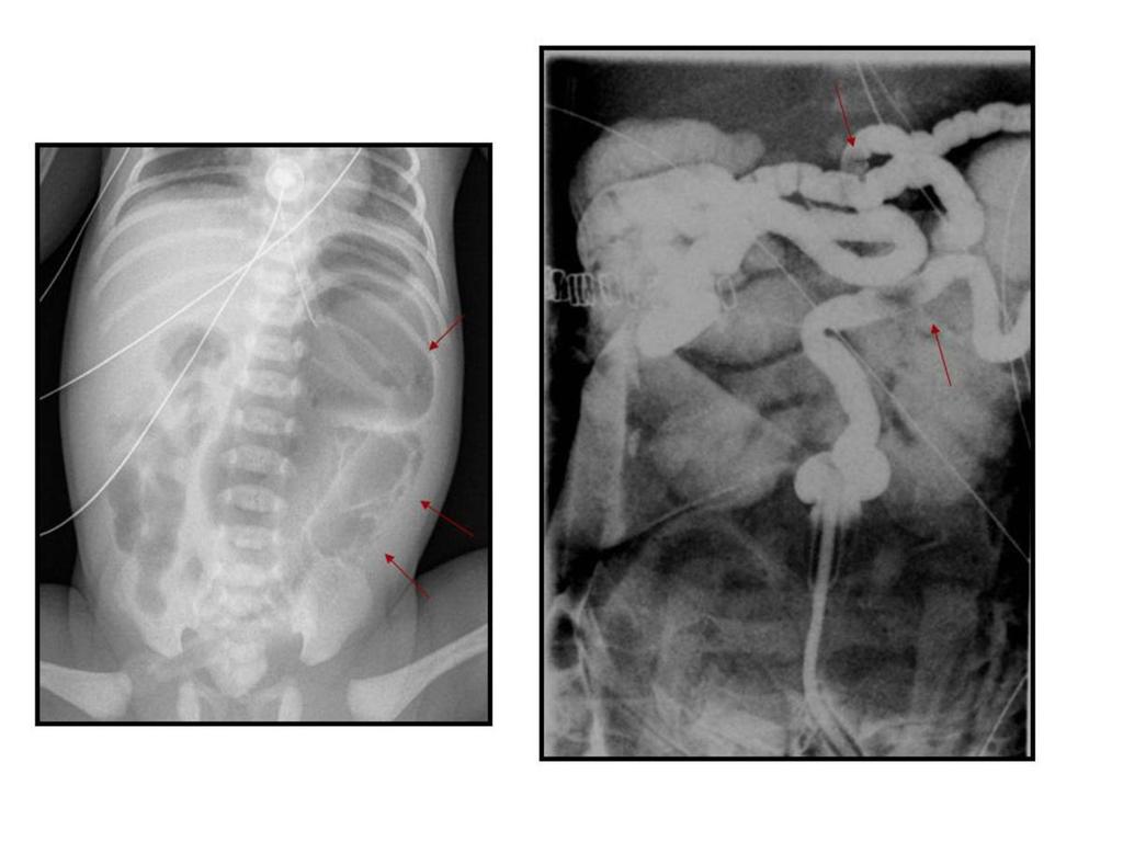 Fig. 19: Newborn with symptoms of a meconium plug syndrome A.