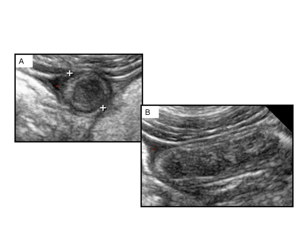 Fig. 21: 8-year-old girl with cystic fibrosis. Ultrasound shows enlarged appendix with mucous inspissation.