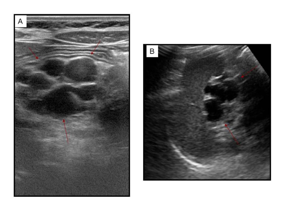 Fig. 5: Figure A and B show complete replacement of the pancreatic parenchyma by innumerable cysts (pancreatic cystosis) in a 13-year-old girl with CF.