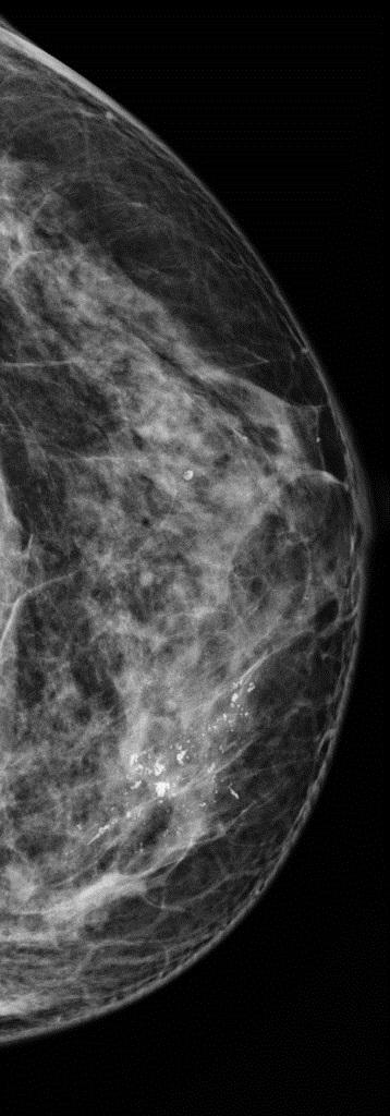 Aims Examine temporal trends in the incidence of early- and late-stage incidence of breast cancer in NSW women Estimate the