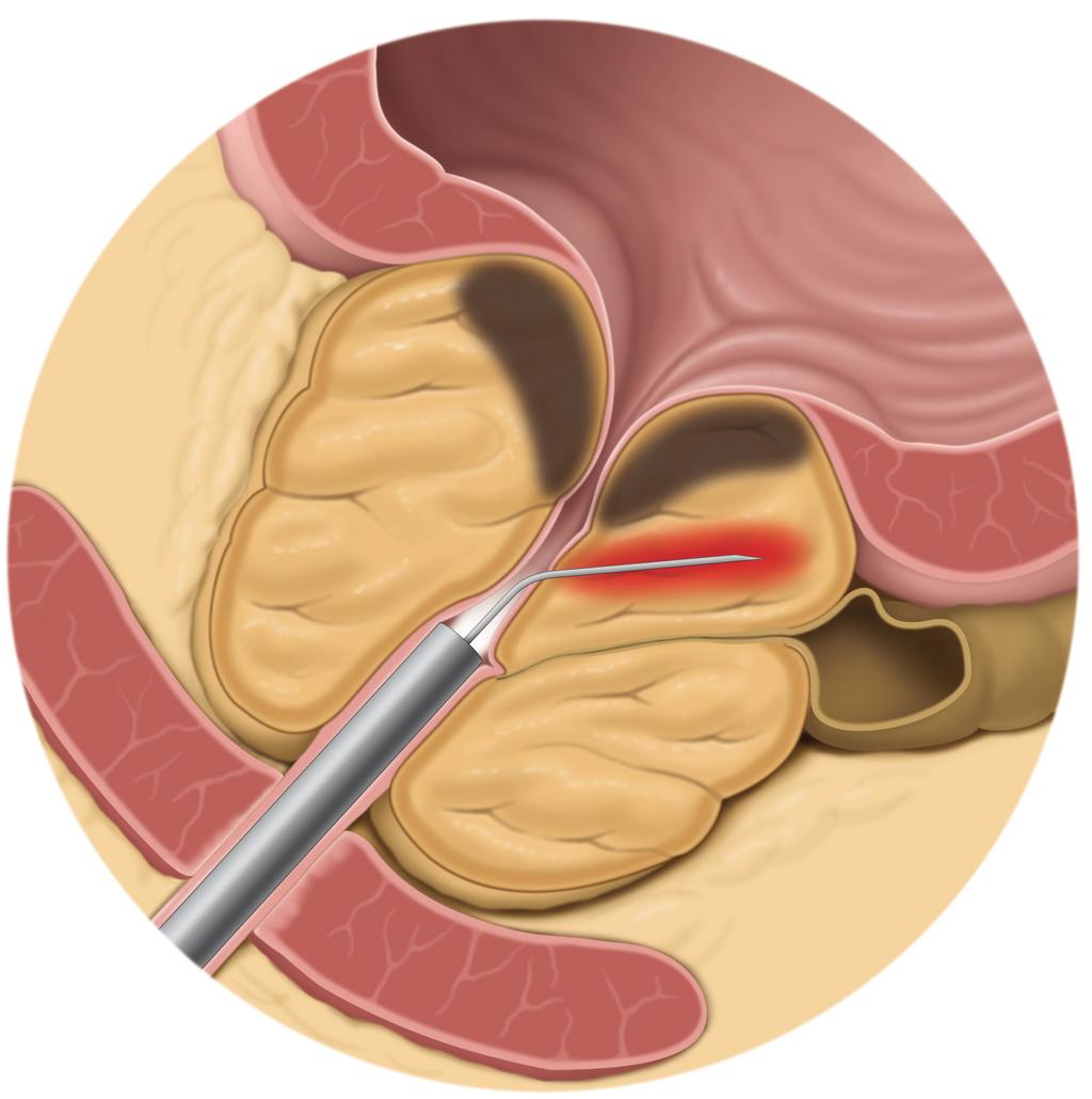 Transurethral needle ablation (TUNA) Transurethral needle ablation (TUNA) of the prostate is minimally invasive treatment which uses heat to harden parts of the prostate tissue.