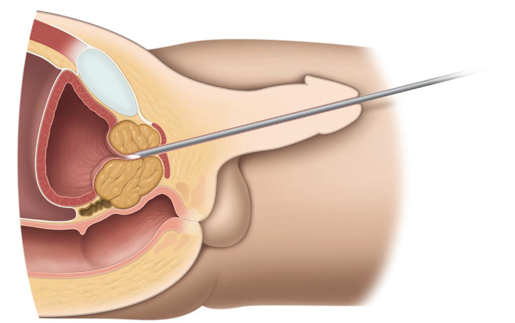 The main procedures are: Transurethral resection of the prostate (TURP) Transurethral incision of the prostate (TUIP) Open prostatectomy Laser treatment Prostate stents Transurethral needle ablation