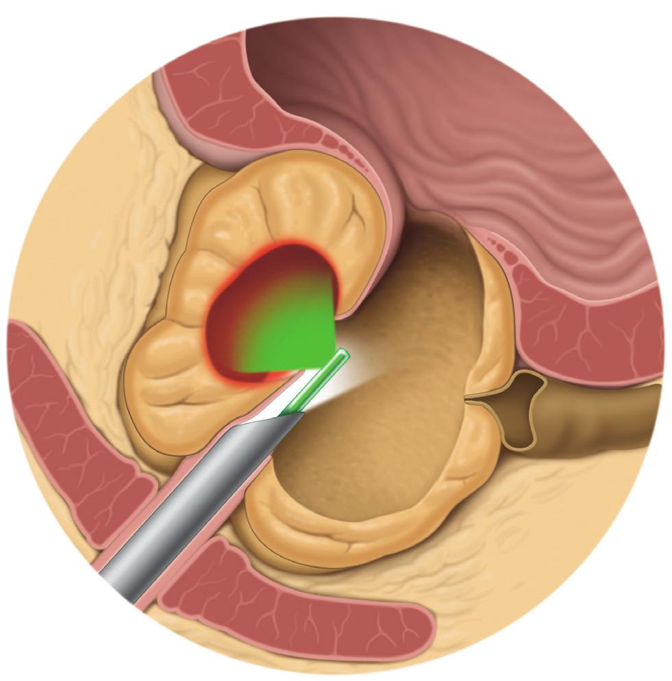 Laser treatment Laser treatment is a common treatment option for BPE. The laser uses intensive light to cut or vaporize the prostate tissue.