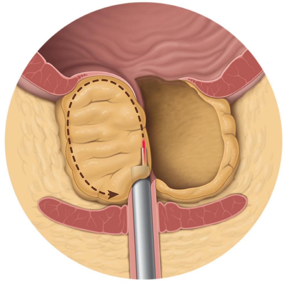 Laser enucleation of the prostate How is laser enucleation performed? For laser enucleation you will receive general, spinal, or intravenous anaesthesia.