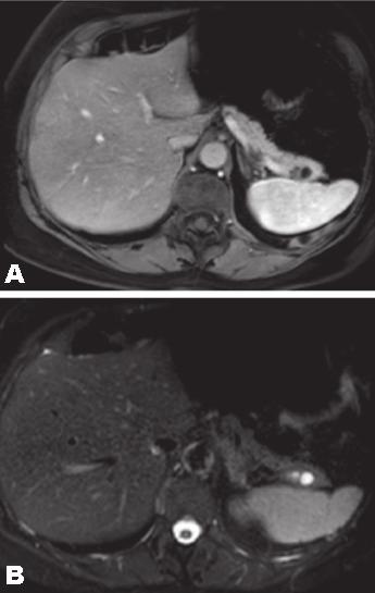 Al Warith et al. 576 (MRI) at three month showed 24 mm cystic loculated lesion (increasing in size comparing to the last CT scan), well demarcated with a thick and contrast enhanced septa (Figure 1).